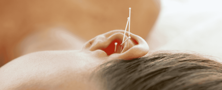 מגלי אשכנזי - רפואה סינית, דיקור סיני מגלי אשכנזי - רפואה סינית, דיקור סיני - דיקור באוזן